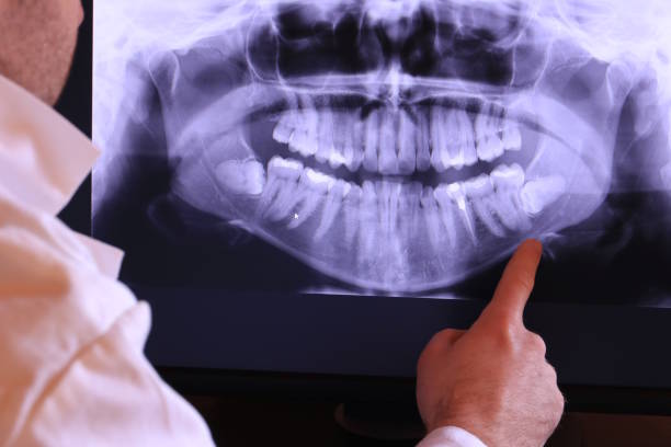 Best Emergency Wisdom Tooth Extraction in USA